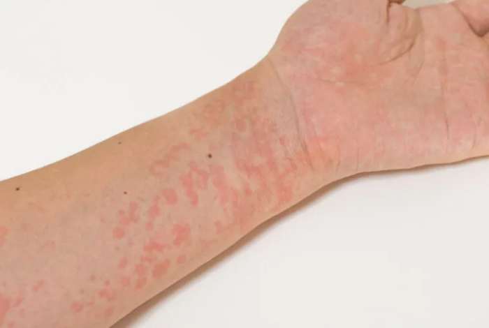 蕁麻疹治療 蕁麻疹治療