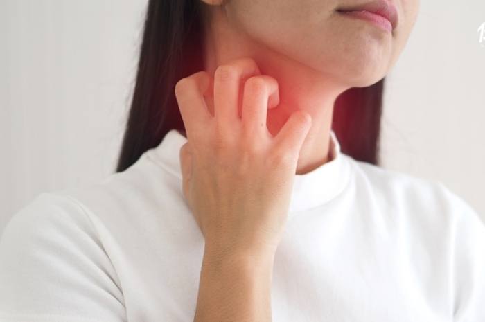 蕁麻疹治療 蕁麻疹治療