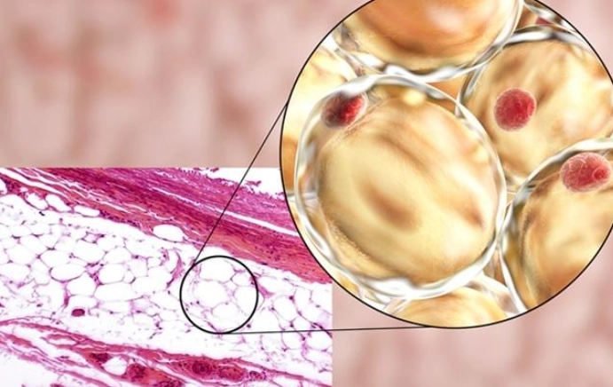 減肥脂肪細胞變化